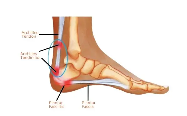 An anatomical illustration of a human foot, highlighting the plantar fascia and related structures and plantar fasciitis marked in red to indicate inflammation or pain.