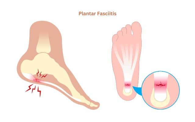 A medical illustration of plantar fasciitis: On the left, a side view of a foot shows the inflamed plantar fascia at the heel, marked with red lines indicating pain. On the right, a bottom view shows the same inflamed area near the heel, with a close-up circle highlighting the damaged tissue.